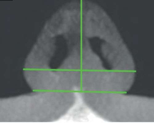 CBCT Nose