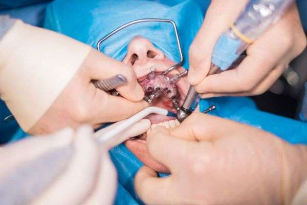 Oral Cavity Surgery
