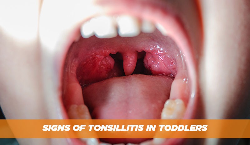 Signs of Tonsillitis in Toddlers