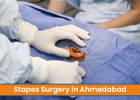 Stapes Surgery in Ahmedabad