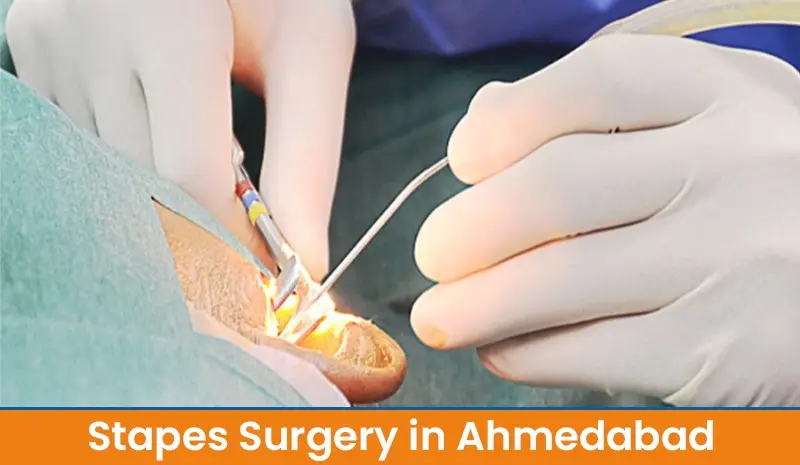 Stapes Surgery in Ahmedabad