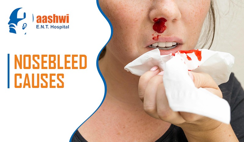 Nosebleed Causes
